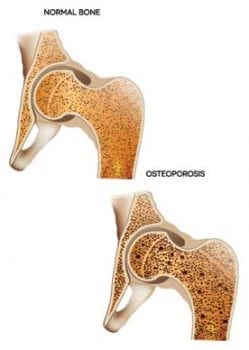 Aging Gracefully, female aging, osteoporosis